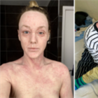 Hundreds contact BBC about mystery skin condition 'hell' - but doctors can't agree it exists